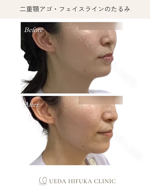 4D Ultra / ハイフ　HIFU 4D Ultra / ハイフ HIFU 4D Ultra / ハイフ HIFU 医療HIFU ウルトラ