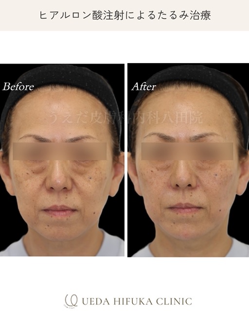 case_hyaluronic_126.jpeg