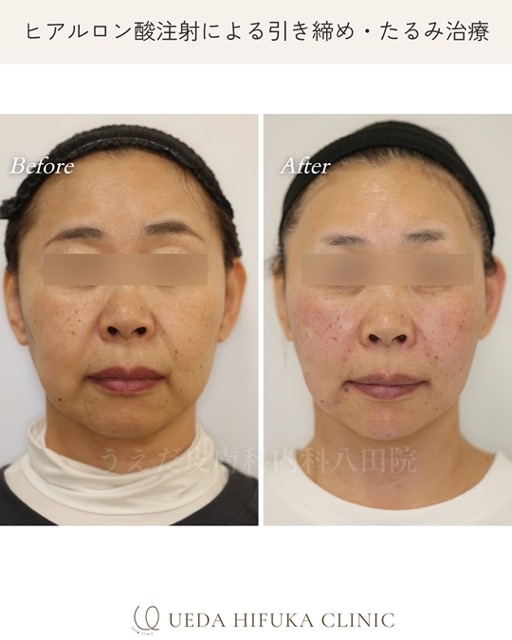 ヒアルロン酸注射【Case No.127】 | うえだ皮膚科内科 八田院 | 名古屋